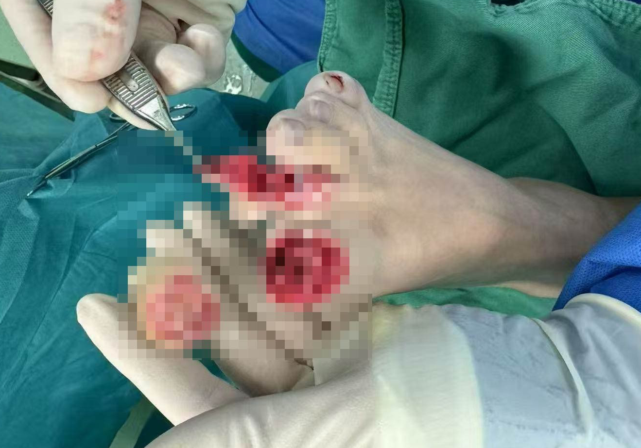 斷趾再植-為患者重塑生命光彩
